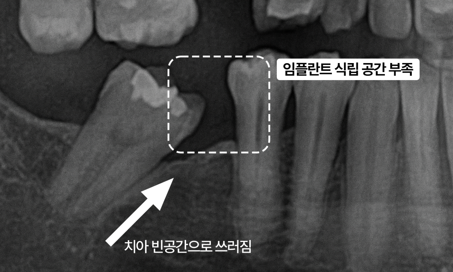치아 빈공간으로 쓰러짐 - 임플란트 식립 공간 부족