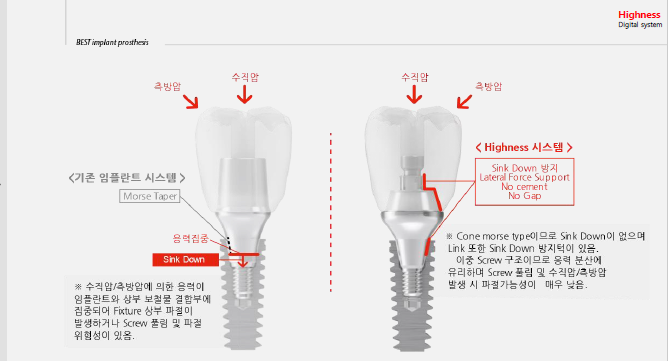 하이니스 임플란트 보철시스템