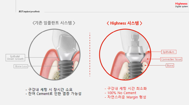 POINT 1 - 진료시간이 짧고 통증이 없는 보철시스템