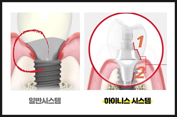 POINT 2 - 인상채득(본뜨기)이 편안한 보철시스템