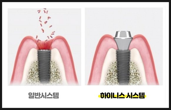 POINT 3 - 세멘을 사용하지 않아 잇몸에 좋은 시스템