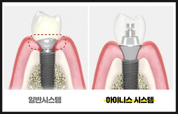 POINT 4 - 2중 안전구조로 오랫동안 안전한 보철시스템