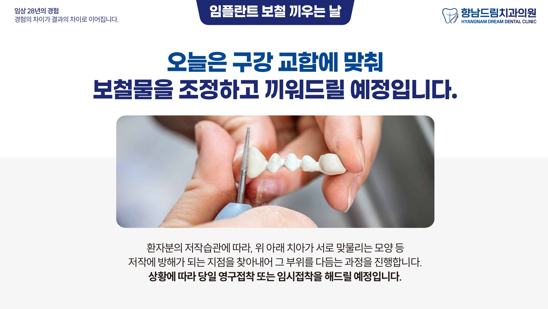 임플란트 보철 끼우는날 과정 1