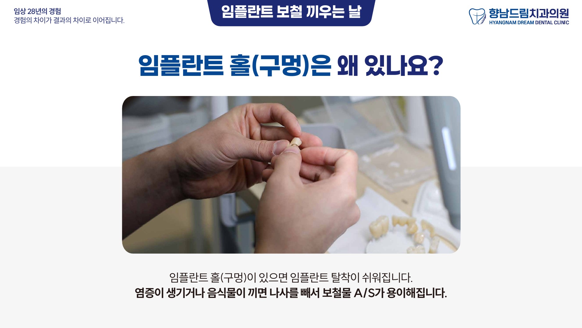 임플란트 보철 끼우는날 과정 2