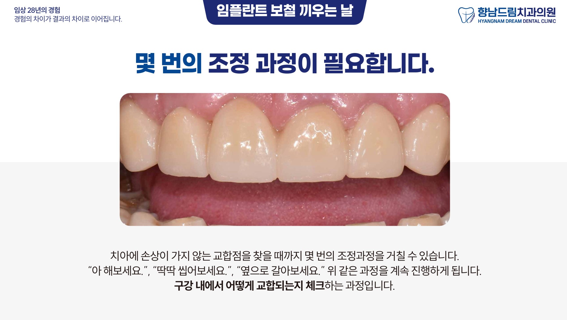 임플란트 보철 끼우는날 과정 3