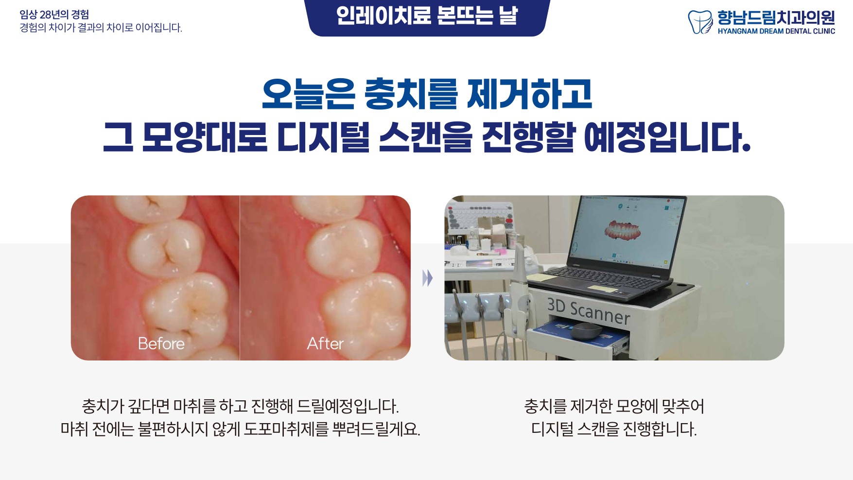 인레이 본뜨는 날 과정 1