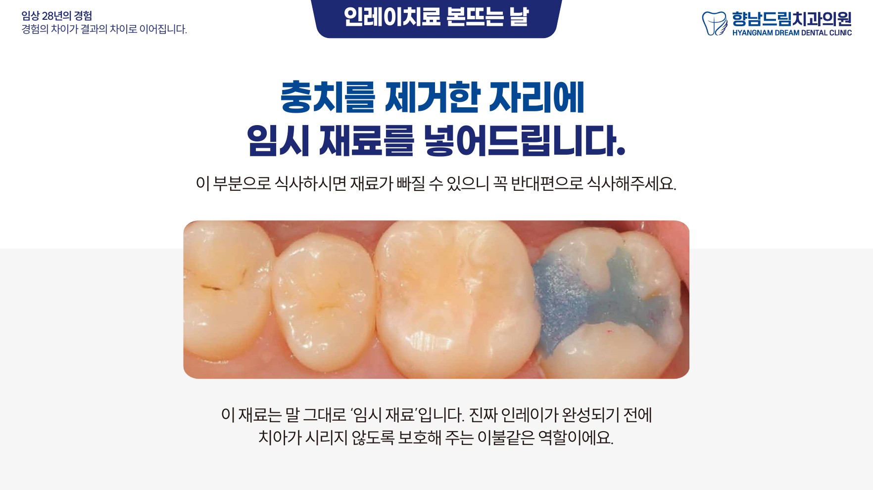 인레이 본뜨는 날 과정 4