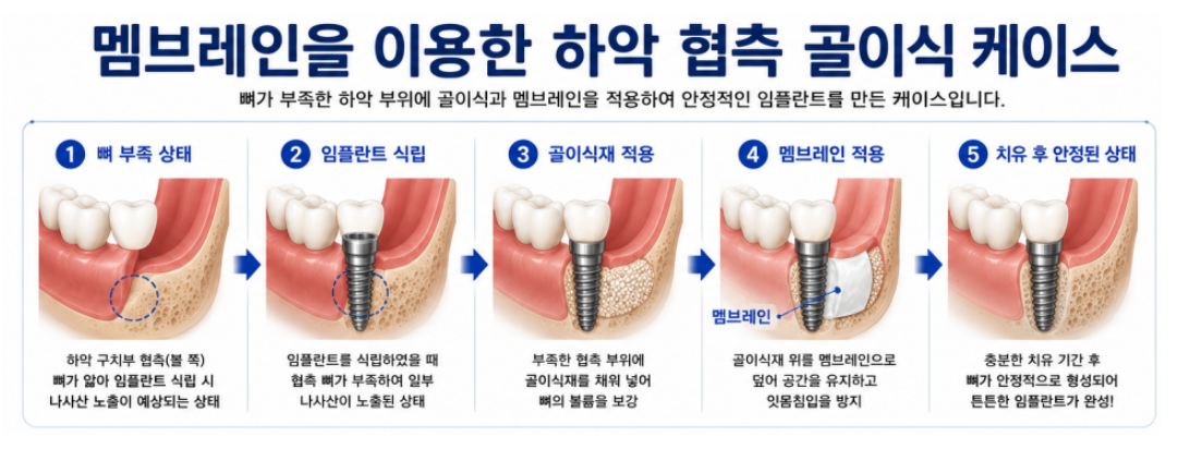 멤브레인을 이용한 하악 협측 골이식 케이스