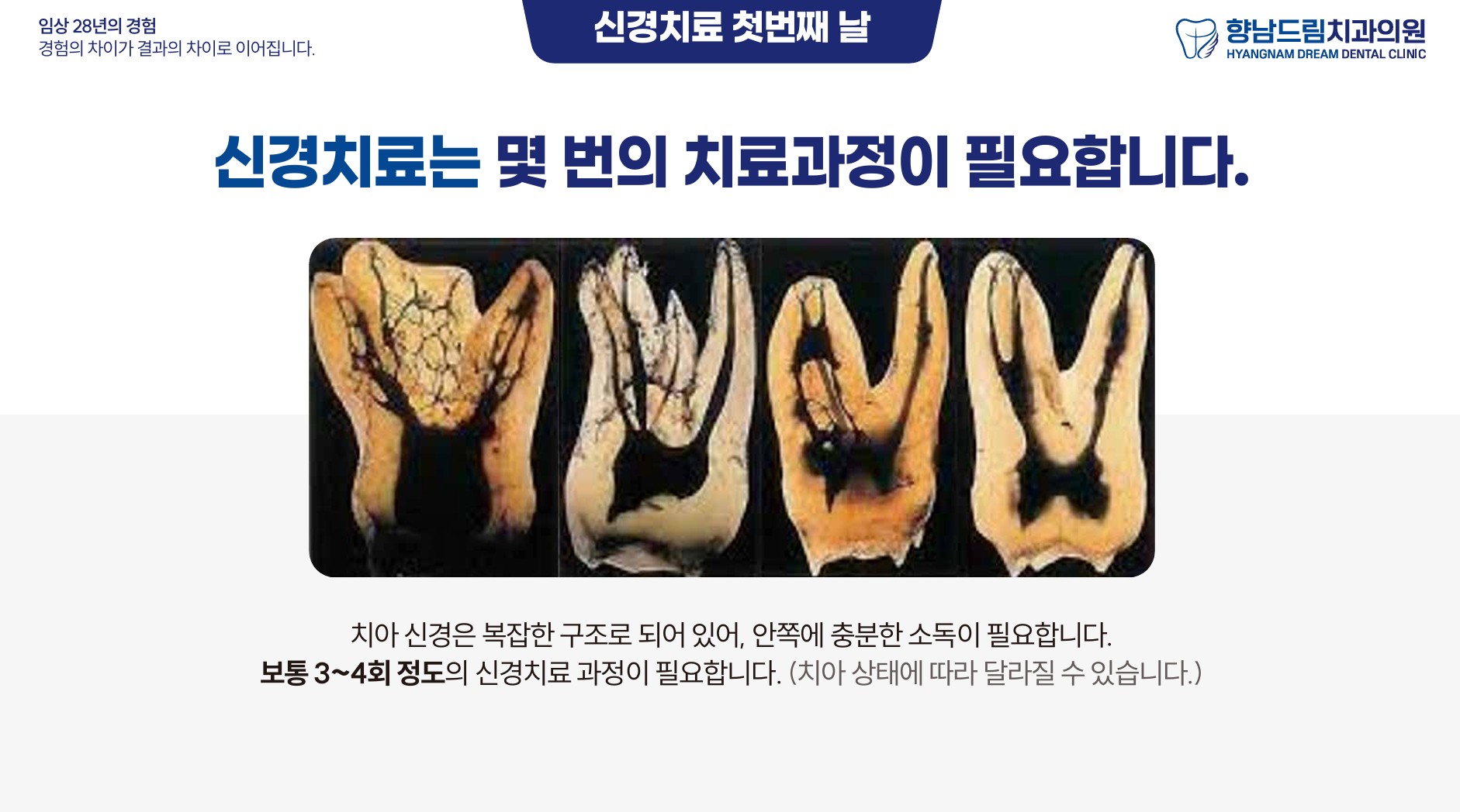 신경치료 첫째날 과정 2