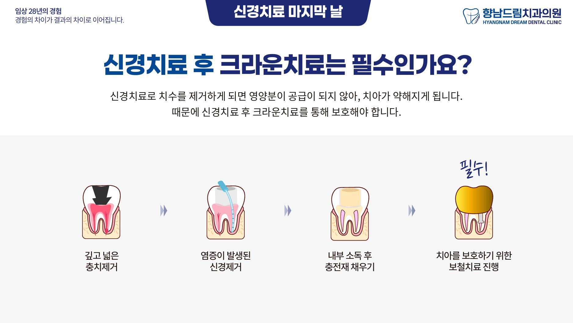신경치료 마지막날 과정 3