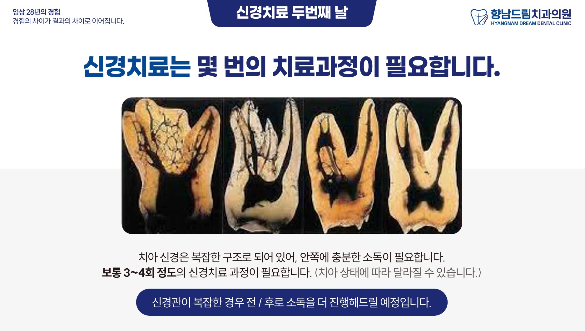 신경치료중간날 과정 3
