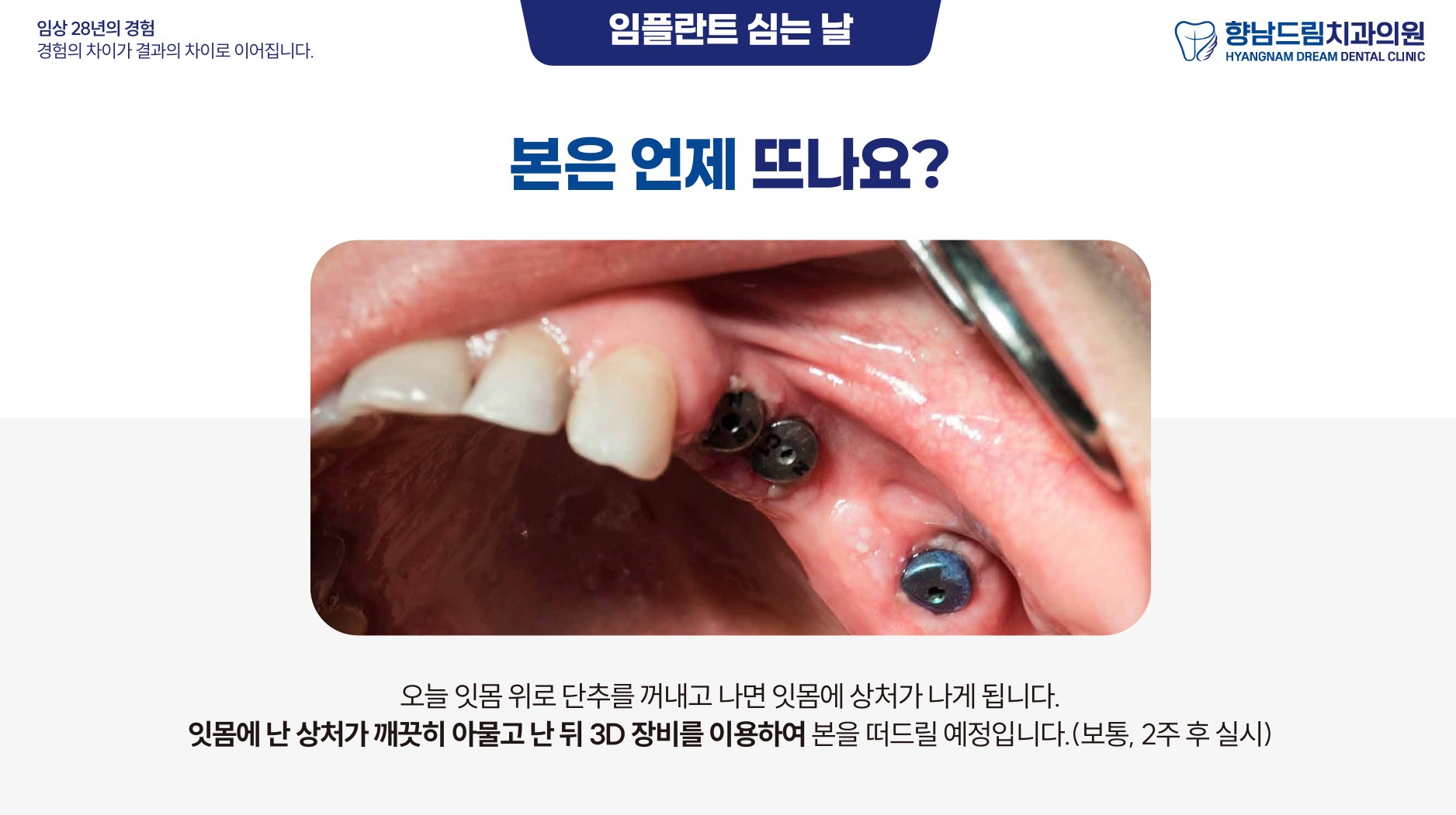 임플란트 2차수술 과정 3