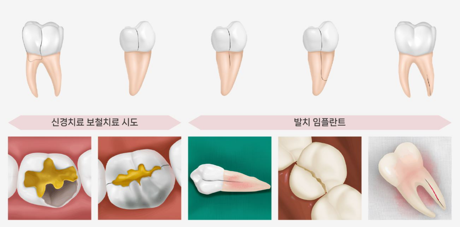 크랙 케이스