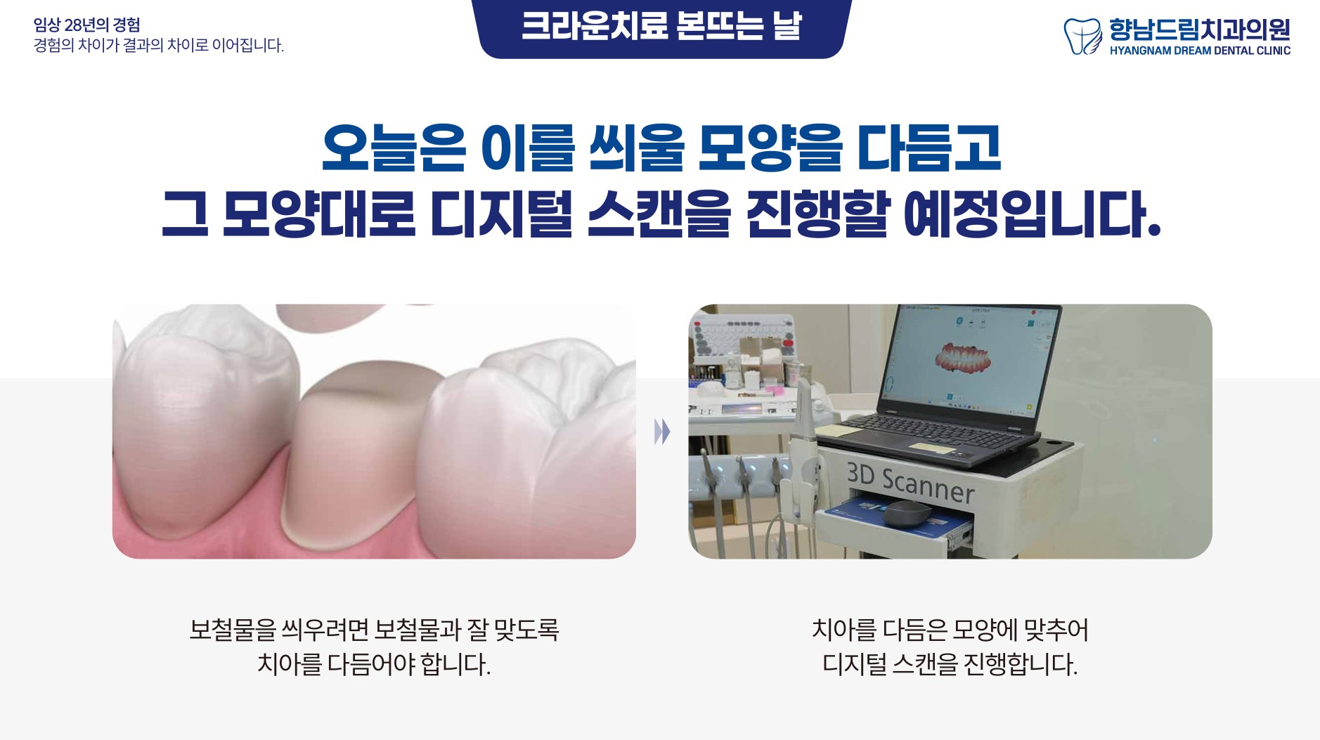 크라운 본뜨는 날 과정 1