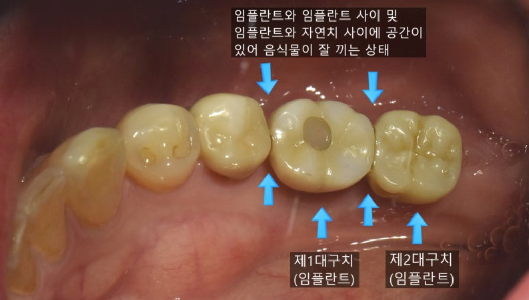 Food impaction 1번케이스 - 음식물 끼임