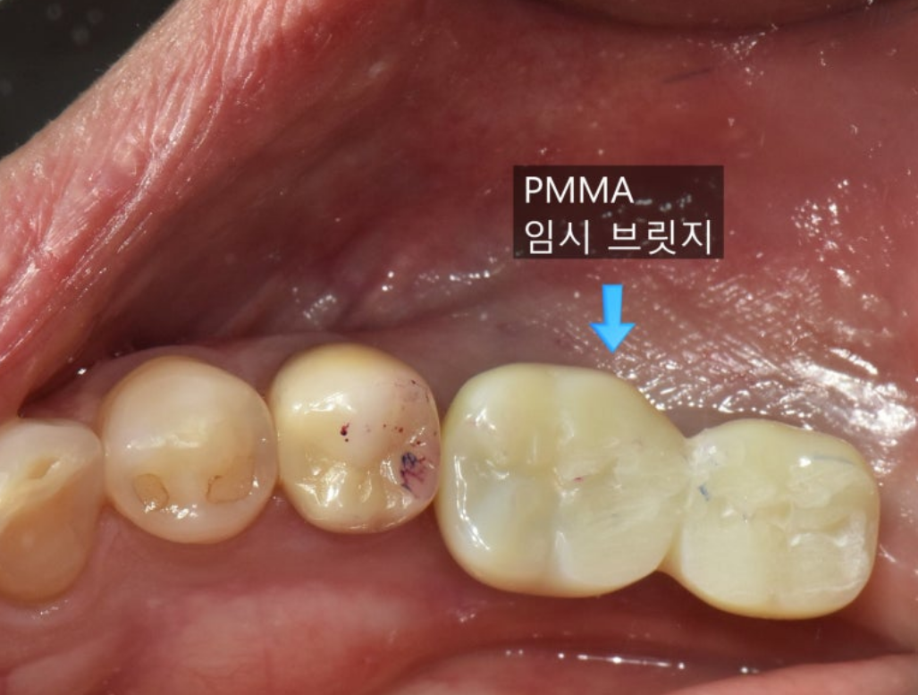 Food impaction 1번케이스 - PMMA 임시 브릿지