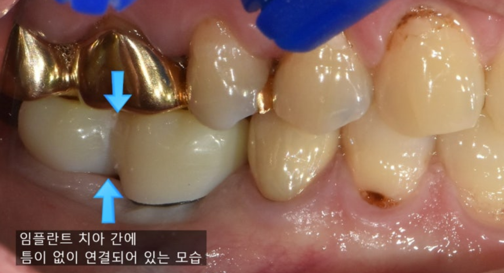 Food impaction 1번케이스 - 밀착