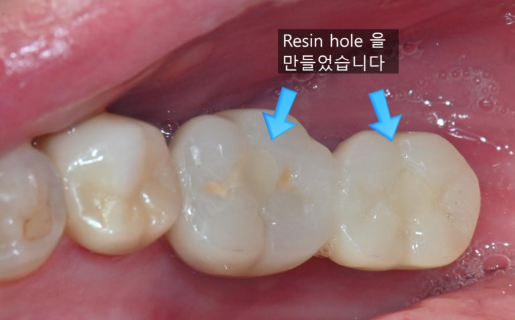 Food impaction 1번케이스 - Resin hole