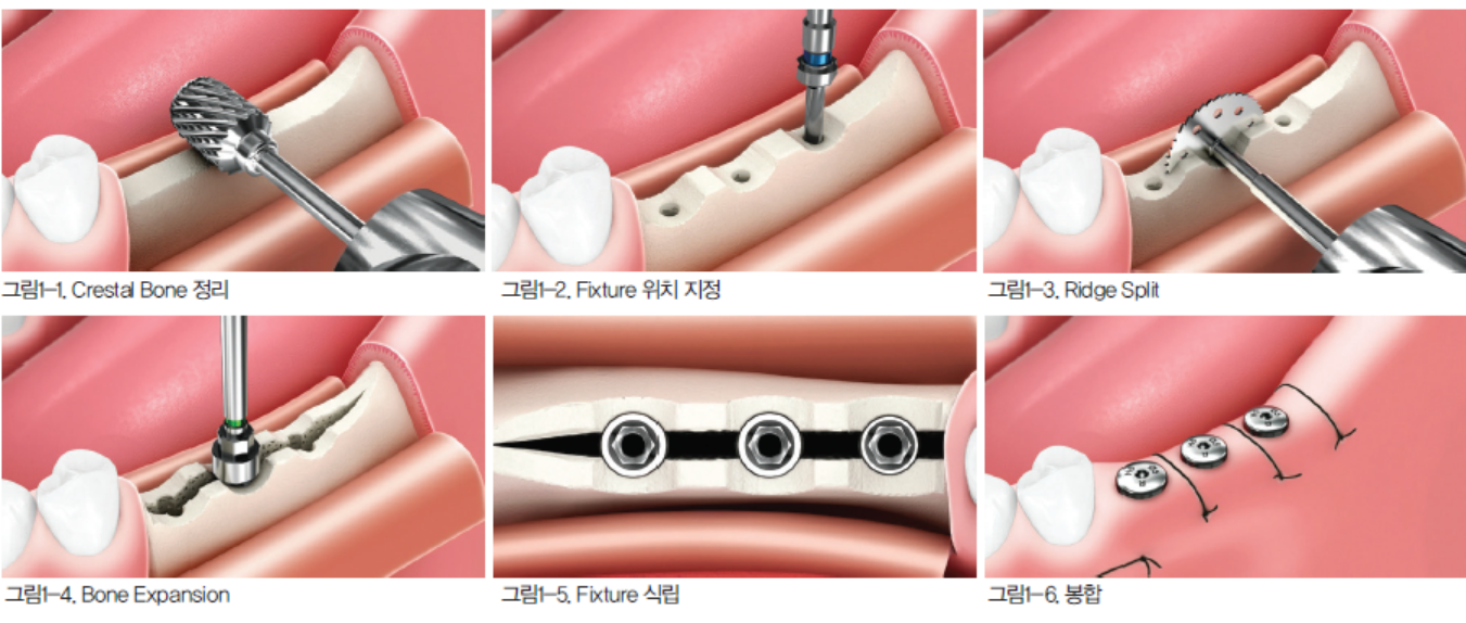 Ridge split 시술 단계