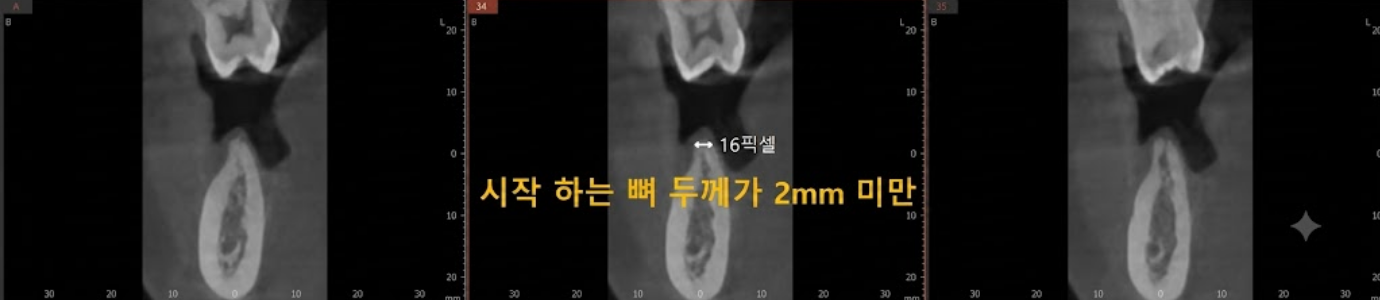 Ridge split 시작 뼈 두께