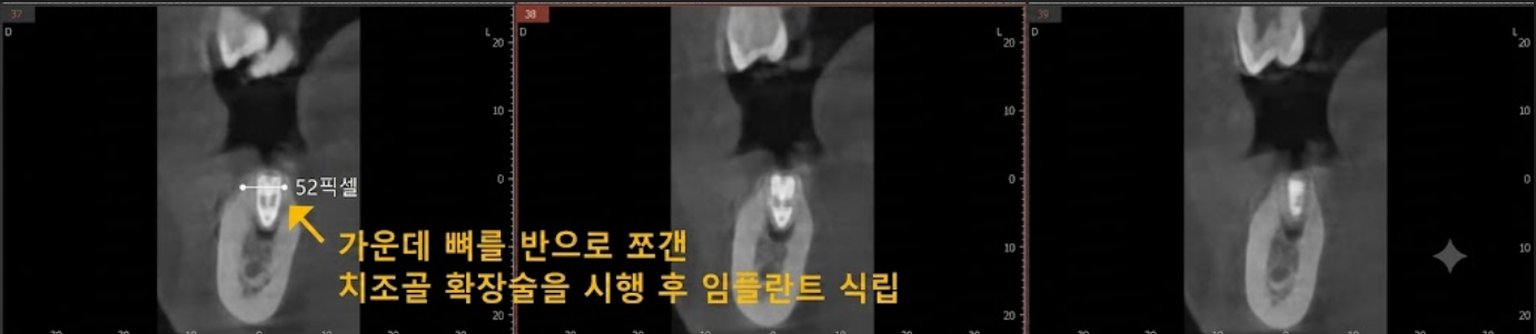 Ridge split 치조골 확장 후 임플란트