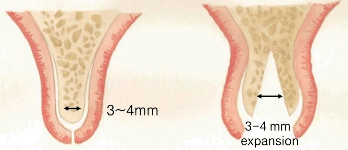Ridge split 3~4mm 확장